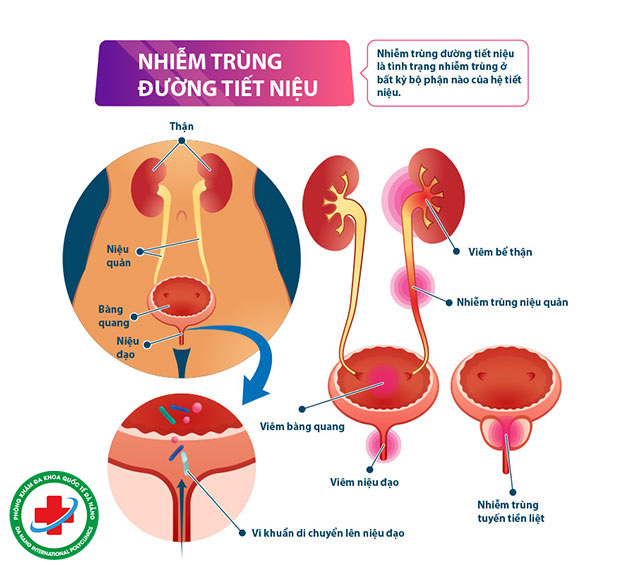 Bệnh viêm đường tiết niệu